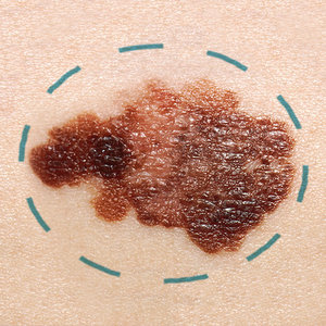 A photograph of an abnormal mole with a circle drawn around it
