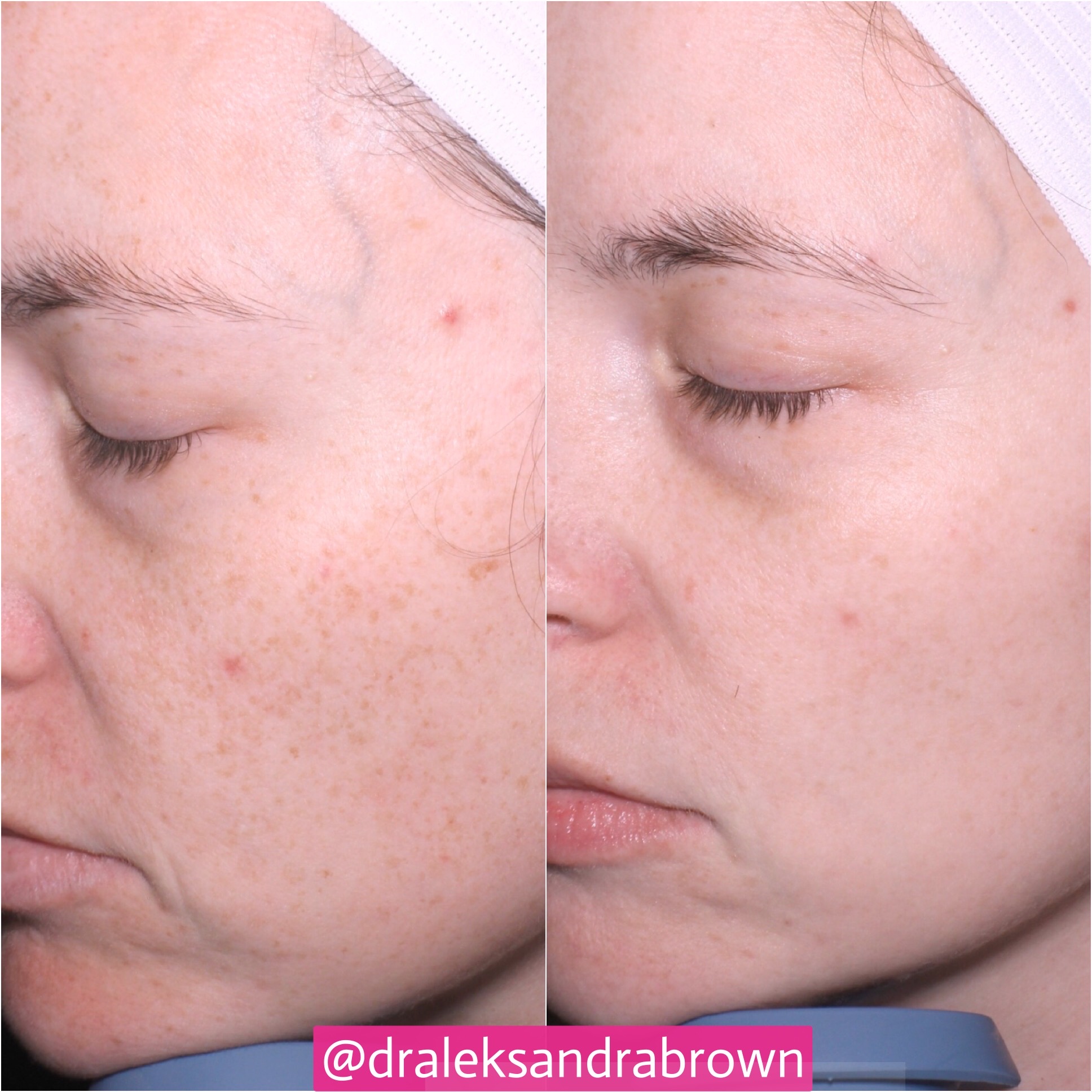 A before and after photo of brown spot removal