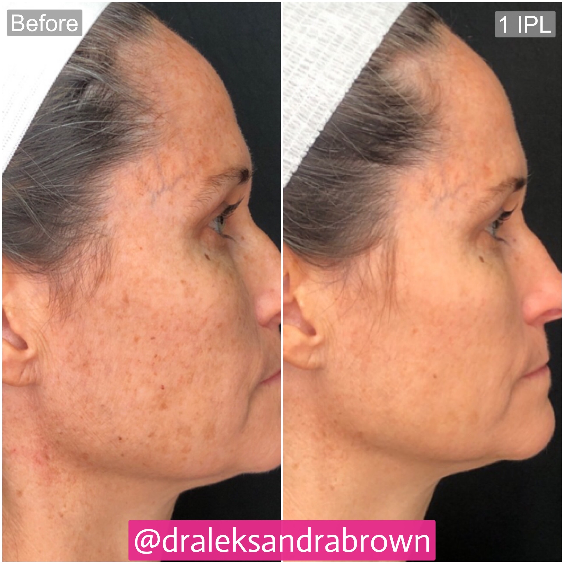 A before and after photo of brown spot removal