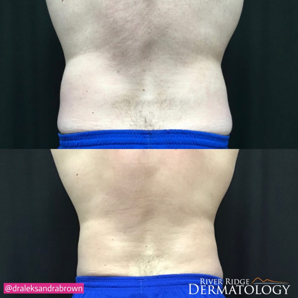 A before and after photo of body contouring