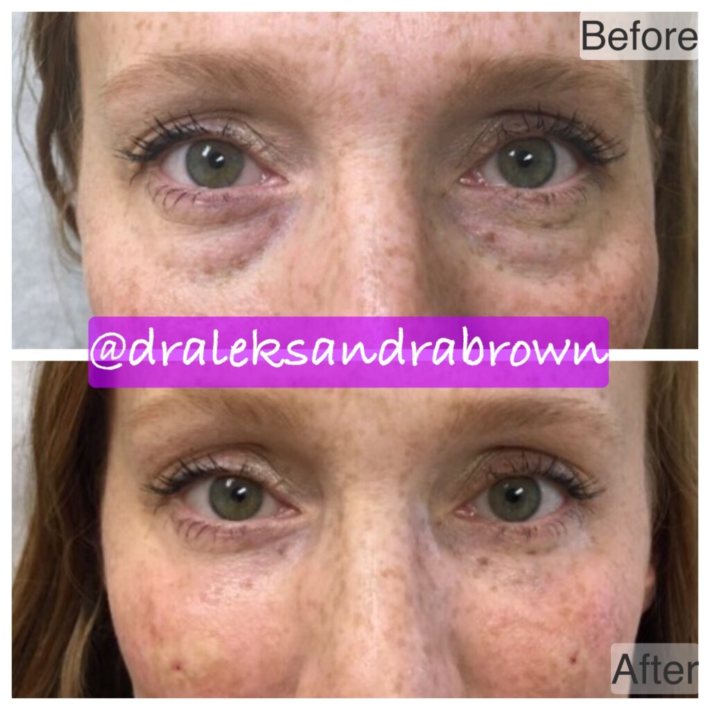 A before and after photo of injectables